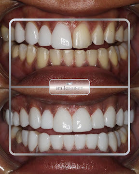 Z-Evolution No-Prep Veneers — All-Inclusive Beirut Experience
