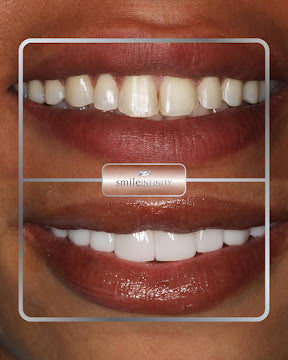 Z-Evolution No-Prep Veneers — All-Inclusive Beirut Experience