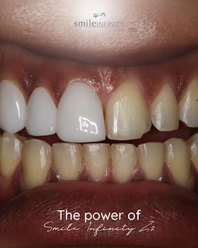 Z-Evolution No-Prep Veneers — All-Inclusive Beirut Experience