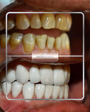 Z-Evolution No-Prep Veneers — All-Inclusive Beirut Experience