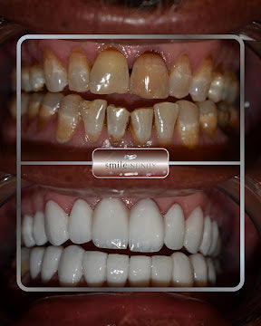 Z-Evolution No-Prep Veneers — All-Inclusive Beirut Experience