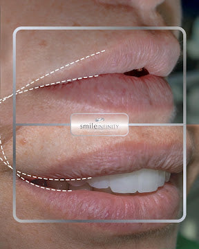 Z-Evolution No-Prep Veneers — All-Inclusive Beirut Experience
