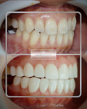 Z-Evolution No-Prep Veneers — All-Inclusive Beirut Experience