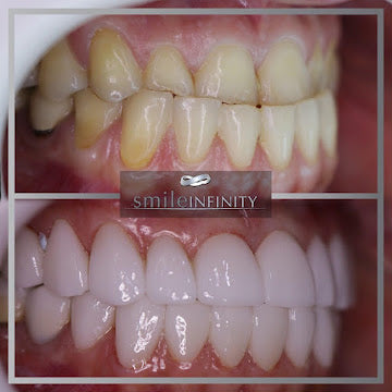 Z-Evolution No-Prep Veneers — All-Inclusive Beirut Experience