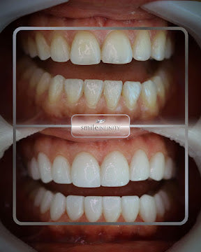 Z-Evolution No-Prep Veneers — All-Inclusive Beirut Experience