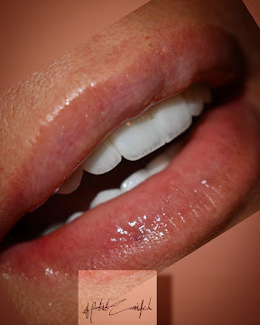 Z-Evolution No-Prep Veneers — All-Inclusive Beirut Experience