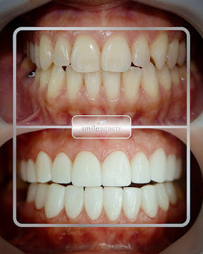 Z-Evolution No-Prep Veneers — All-Inclusive Beirut Experience