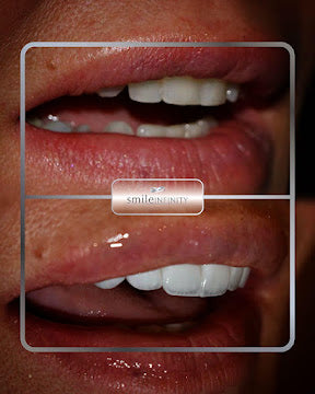 Z-Evolution No-Prep Veneers — All-Inclusive Beirut Experience