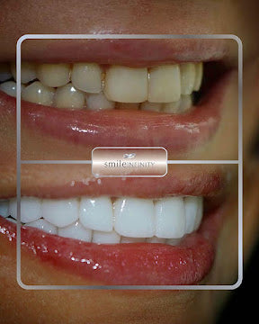 Z-Evolution No-Prep Veneers — All-Inclusive Beirut Experience