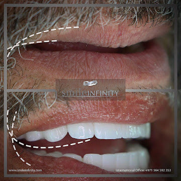 One Day Dental Implant — Beirut by Smile Infinity®