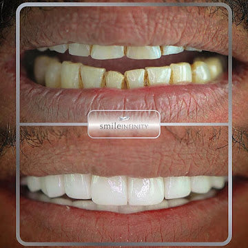 Z-Evolution No-Prep Veneers — All-Inclusive Beirut Experience