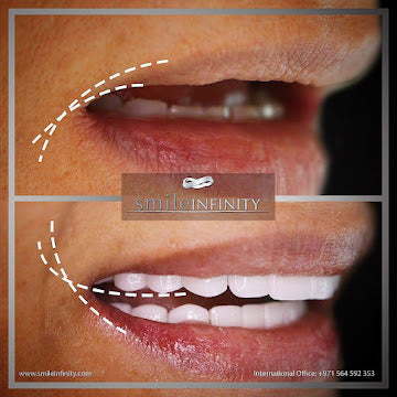 One Day Dental Implant — Beirut by Smile Infinity®