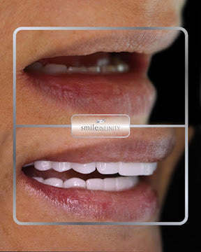 Z-Evolution No-Prep Veneers — All-Inclusive Beirut Experience