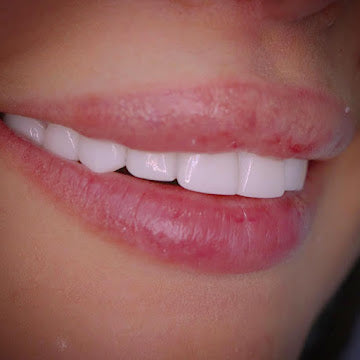 Z-Evolution No-Prep Veneers — All-Inclusive Beirut Experience