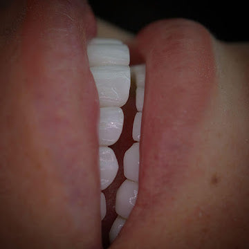 Z-Evolution No-Prep Veneers — All-Inclusive Beirut Experience