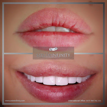 Z-Evolution No-Prep Veneers — All-Inclusive Beirut Experience