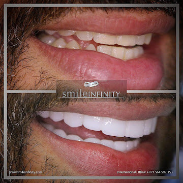 Z-Evolution No-Prep Veneers — All-Inclusive Beirut Experience