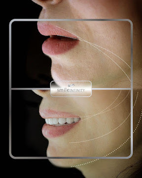 Z-Evolution No-Prep Veneers — All-Inclusive Beirut Experience