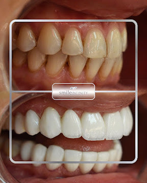Z-Evolution No-Prep Veneers — All-Inclusive Beirut Experience