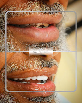 Z-Evolution No-Prep Veneers — All-Inclusive Beirut Experience