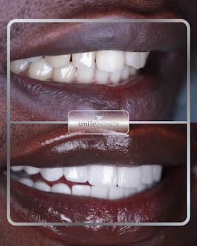 Z-Evolution No-Prep Veneers — All-Inclusive Beirut Experience