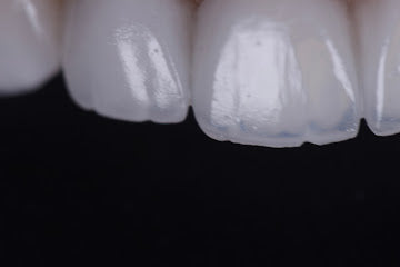 Z-Evolution No-Prep Veneers — All-Inclusive Beirut Experience