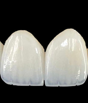 Z-Evolution No-Prep Veneers — All-Inclusive Beirut Experience
