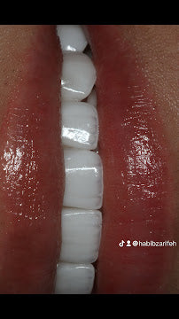 Z-Evolution No-Prep Veneers — All-Inclusive Beirut Experience
