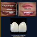 Z-Evolution No-Prep Veneers — All-Inclusive Beirut Experience