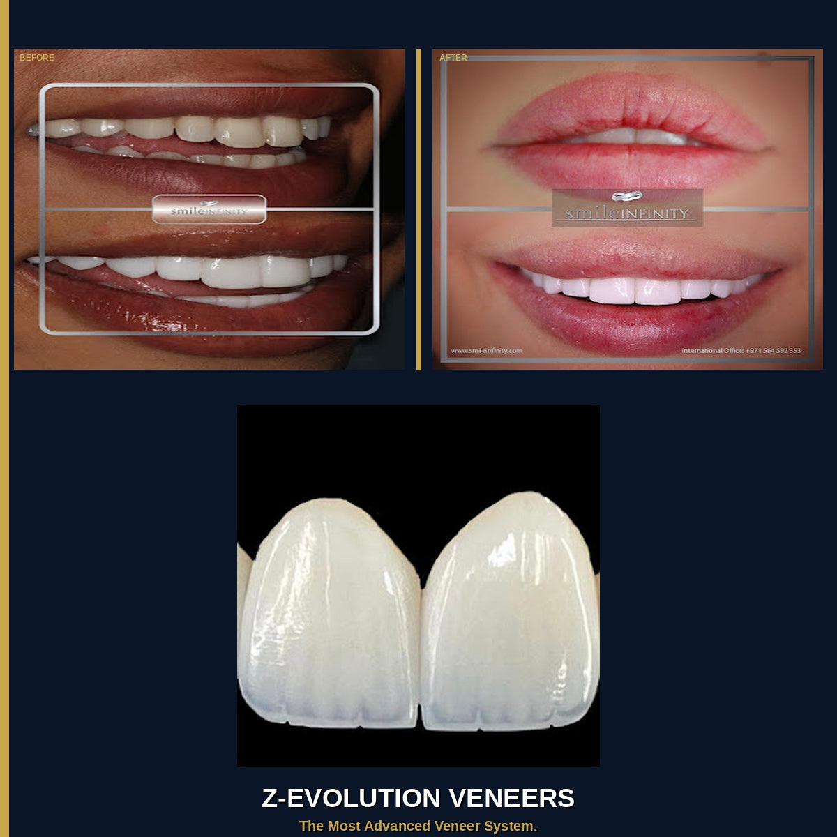 Z-Evolution No-Prep Veneers — All-Inclusive Beirut Experience
