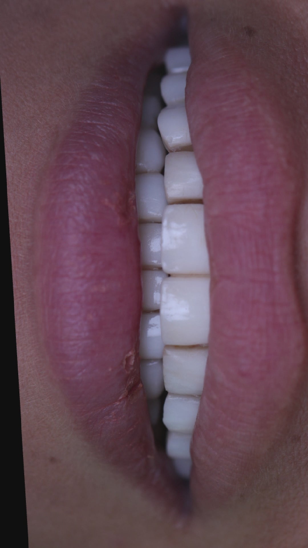 One Day Dental Implant — Beirut by Smile Infinity®